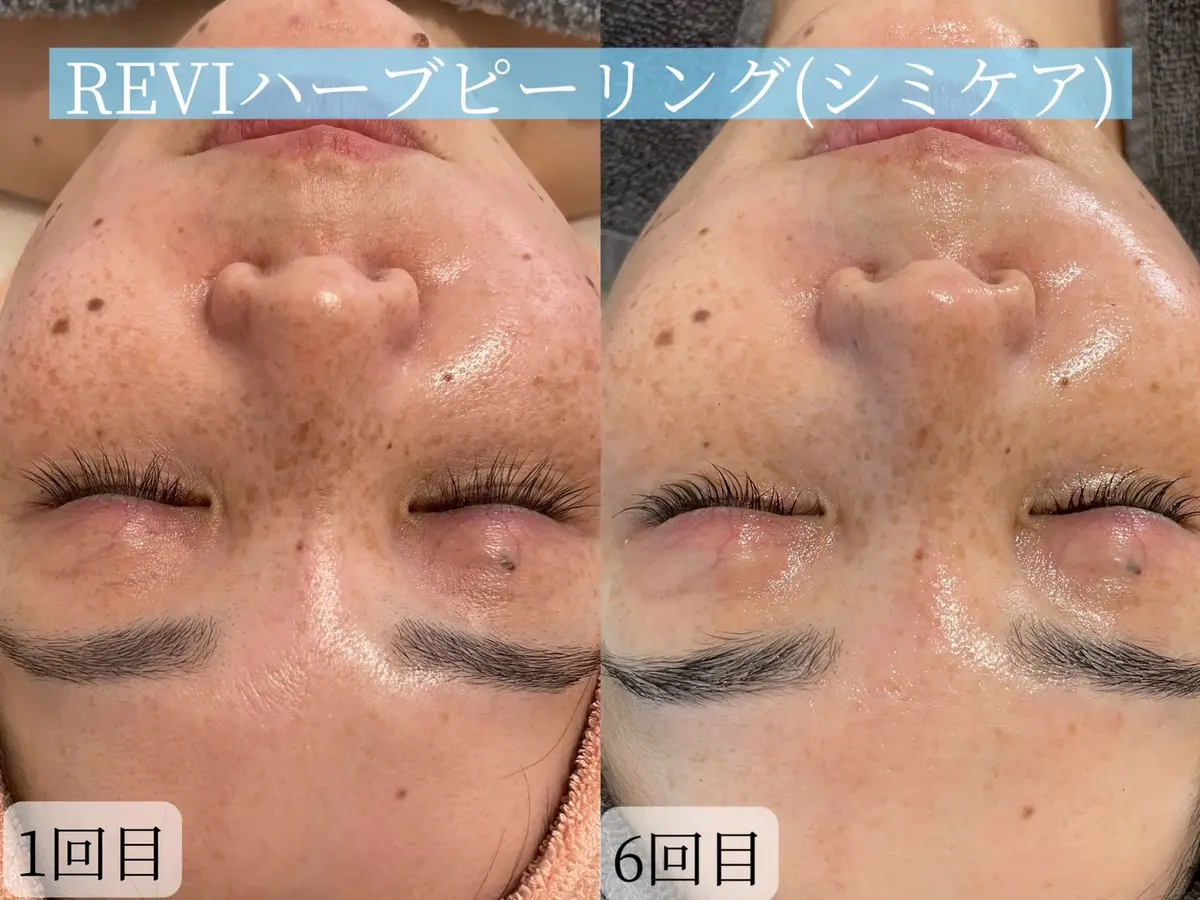 salon de ete【サロンドエテ】/ ドライヘッドスパ＆ハーブピーリング / 合志 - 6